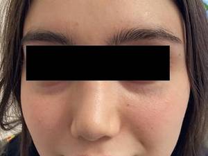 قیمت تزریق فیلر زیر چشم برای بانوان در یزد