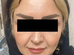 قیمت لیفت صورت با نخ کاگ در یزد