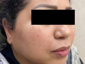 قیمت لیفت صورت با نخ کاگ در یزد