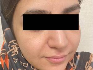 قیمت لیفت صورت با نخ کاگ در یزد