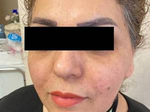 قیمت لیفت صورت با نخ کاگ در یزد