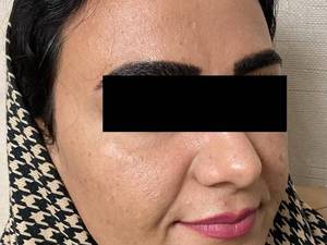 قیمت لیفت صورت با نخ کاگ در یزد