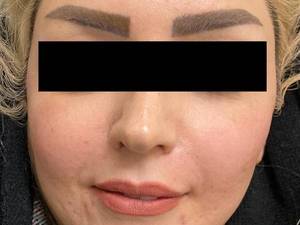 قیمت لیفت صورت با نخ کاگ در یزد