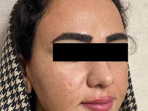 قیمت لیفت صورت با نخ کاگ در یزد