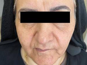 انجام لیفت صورت با نخ کاگ برای سنین بالا