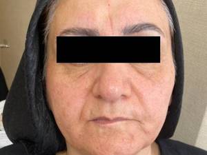 انجام لیفت صورت با نخ کاگ برای سنین بالا