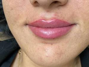 تزریق ژل لب با برند پرفکتای فرانسه