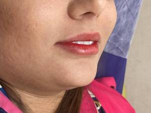 تزریق ژل لب با برند پرفکتای فرانسه