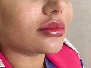تزریق ژل لب با برند پرفکتای فرانسه