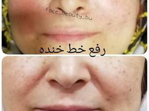 رفع خط خنده در بوشهر