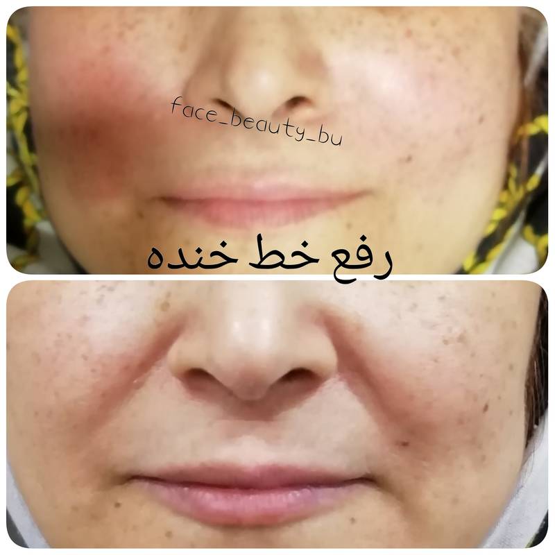 رفع خط خنده در بوشهر