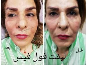 لیفت فول فیس در بوشهر