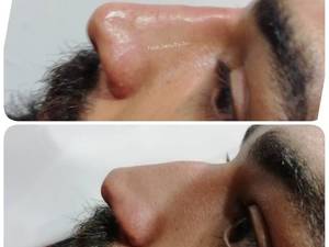 لیفت ورفع قوزبینی بدون عمل در بوشهر