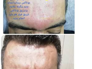 قیمت بوتاکس پیشانی در بوشهر