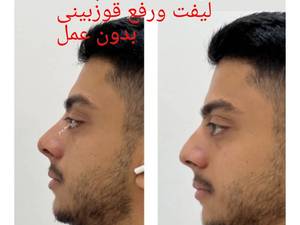 لیفت ورفع قوزبینی بدون عمل 