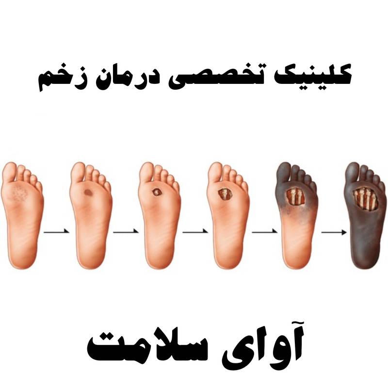 درمان زخم دیابتی