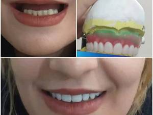قیمت دندان مصنوعی طرح لمینت در اصفهان