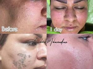 هزینه خدمات سينرژي پيل برای مشکلات پوستی