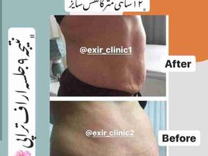 عمل لیفت