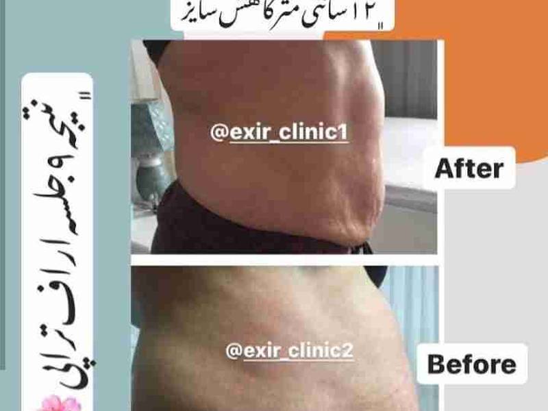 عمل لیفت