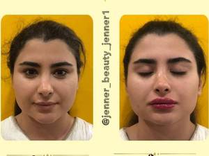 هزینه تزریق فیلر لب در کرج