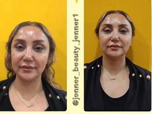 هزینه لیفت صورت با نخ در کرج