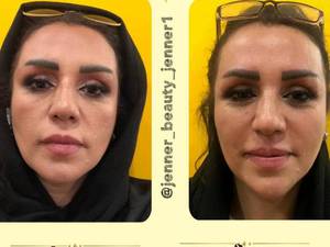 تزریق فیلر چانه