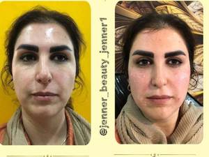 هزینه تزریق فیلر خط خنده و گونه در کرج