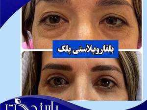 کلینیک تخصصی بلفاروپلاستی در تهران