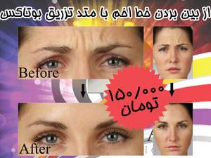 انجام بوتاکس