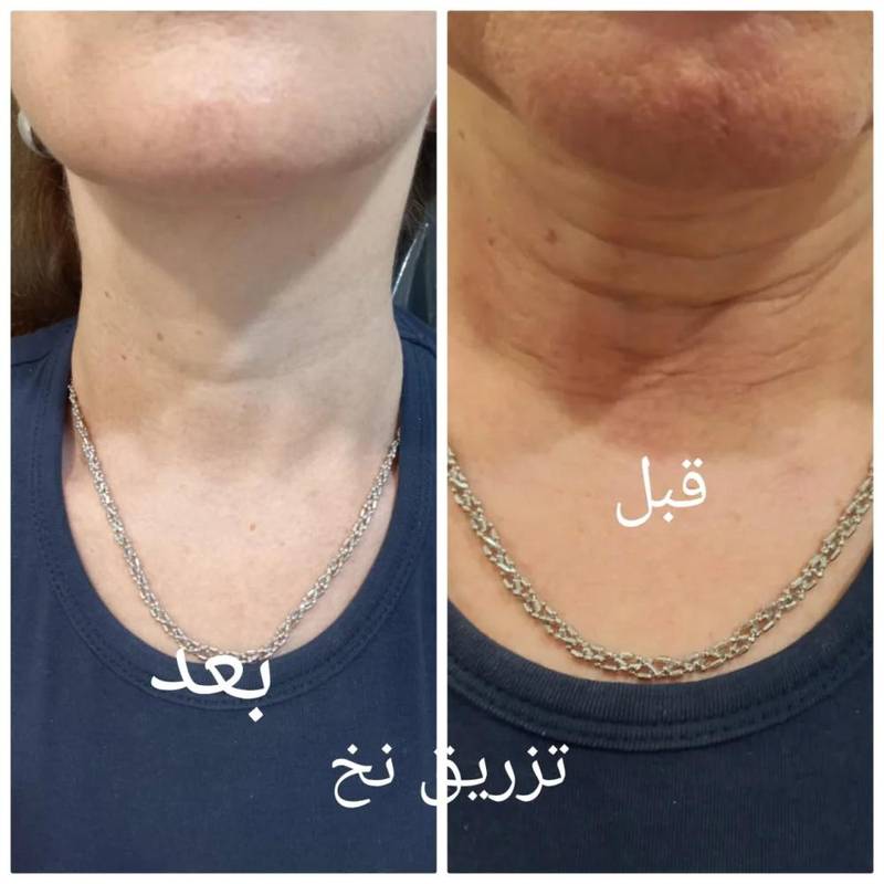 تزریق نخ های کلاژن ساز