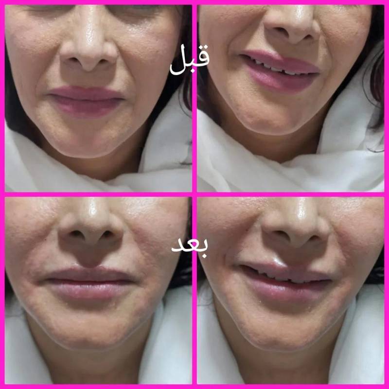 تزریق ژل خط خنده
