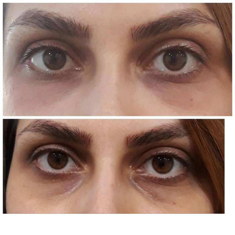 تزریق ژل زیر چشم