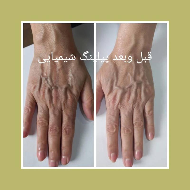هزینه پیلینگ دست
