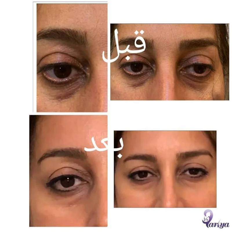 تزریق ژل