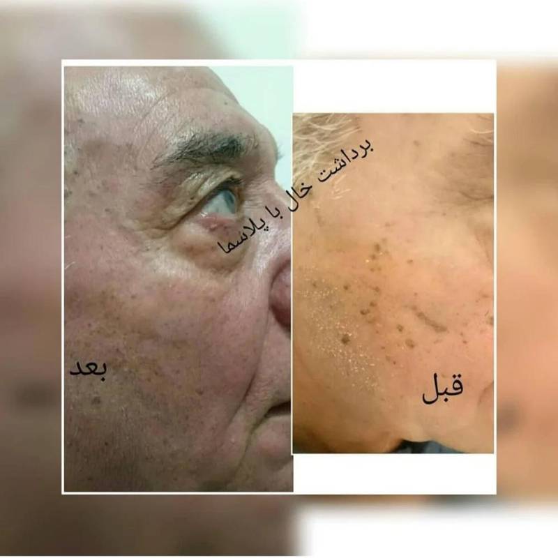 هزینه برداشتن خال سطحی