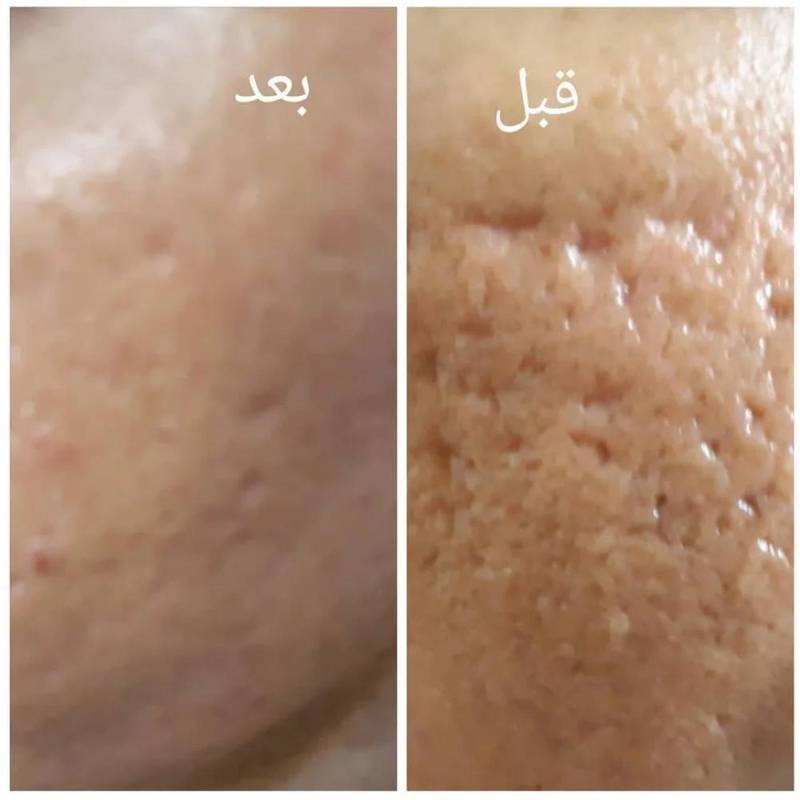 یکرونیدلینگ ویکتور هوگو پلکسی