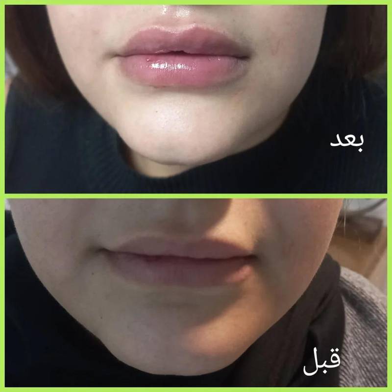 تزریق ژل(فیلر)