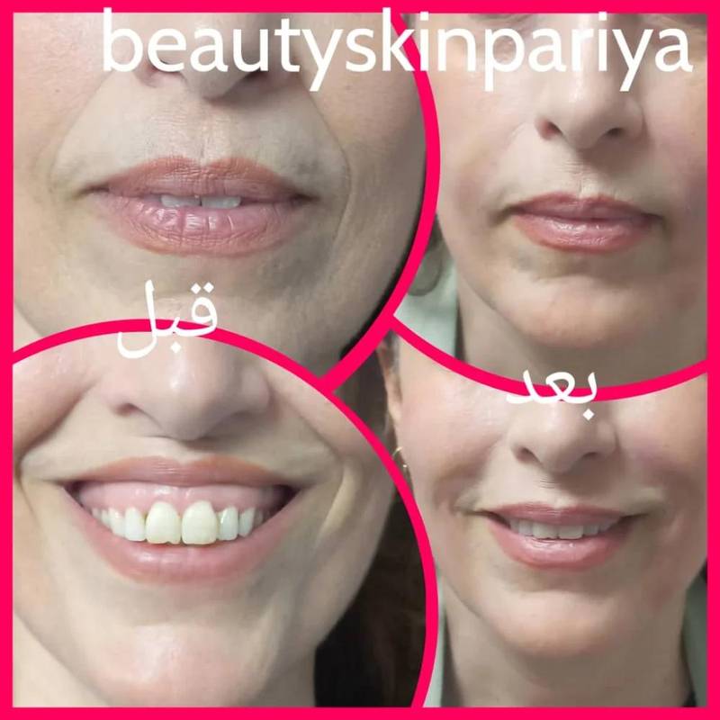 تزریق ژل