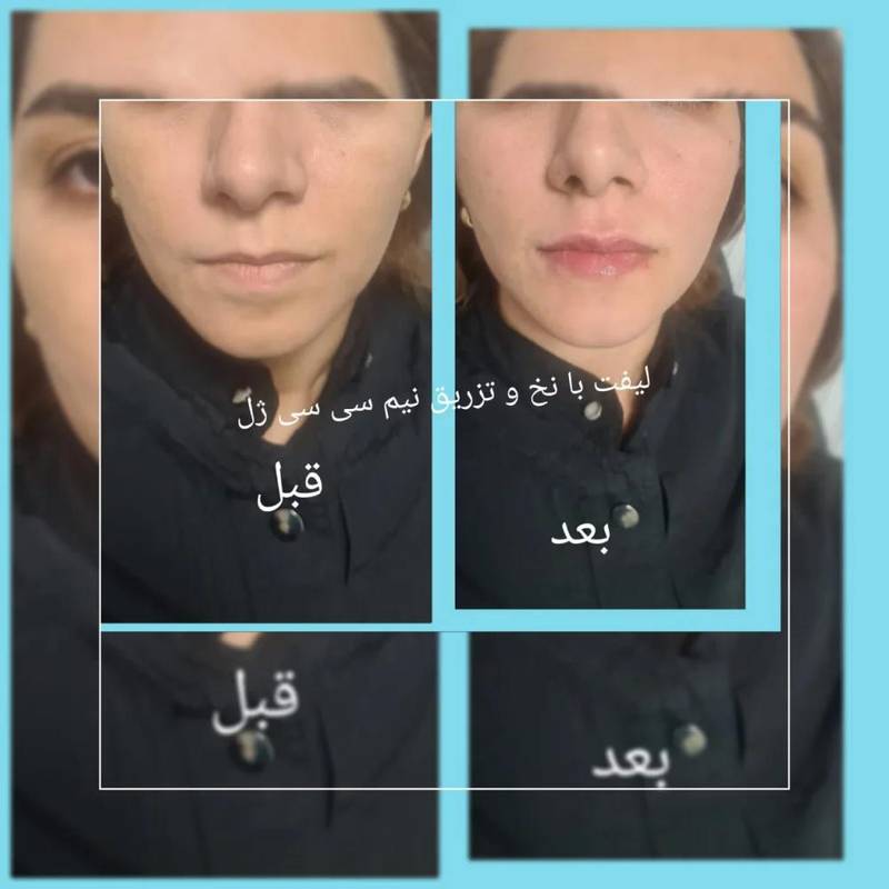 لیفت صورت با تزریق نخهای مونو
