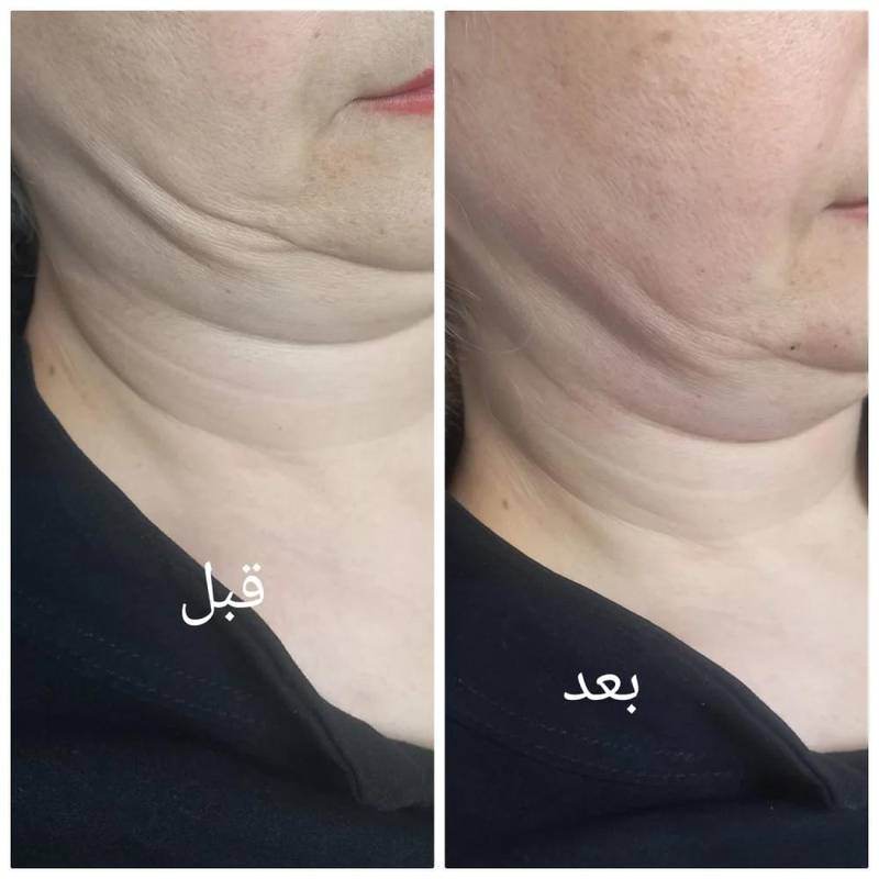 تزریق چربی سوز چربی ها