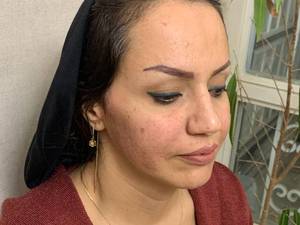 لیفت صورت با نخ در یزد