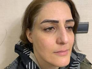 مادلینگ صورت با فیلر با قیمت مناسب