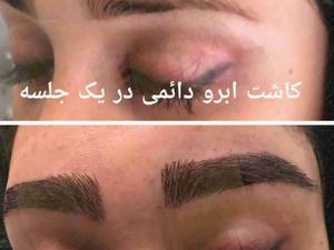 کاشت ابرو