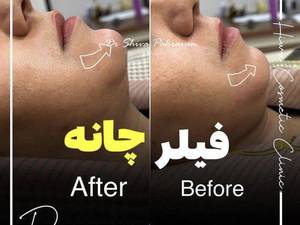 قیمت تزریق ژل به چانه