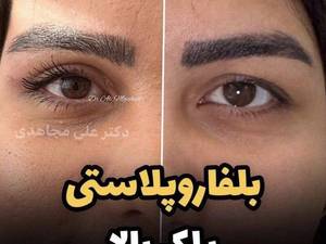عمل بلفاروپلاستی یا جراحی پلک