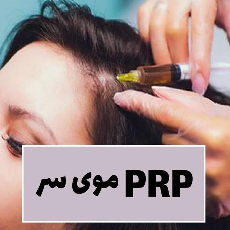 مزایای پی آر پی (PRP)