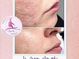 روش آر اف فرکشنال