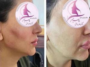 تزريق فیلر جهت زاویه سازی فک و گونه کرمانشاه