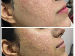 کلینک میکرونیدلینگ در کرمانشاه